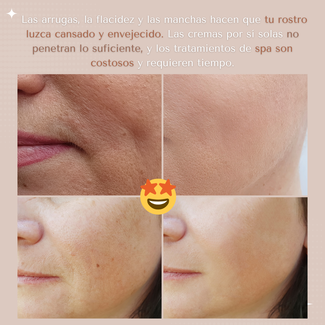 Electroporación Facial + Gel conductor GRATIS